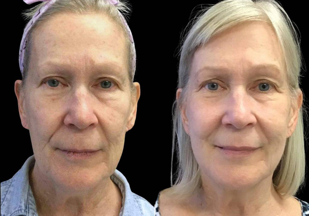 65-year-old-female-kybella-before-and-after.jpg