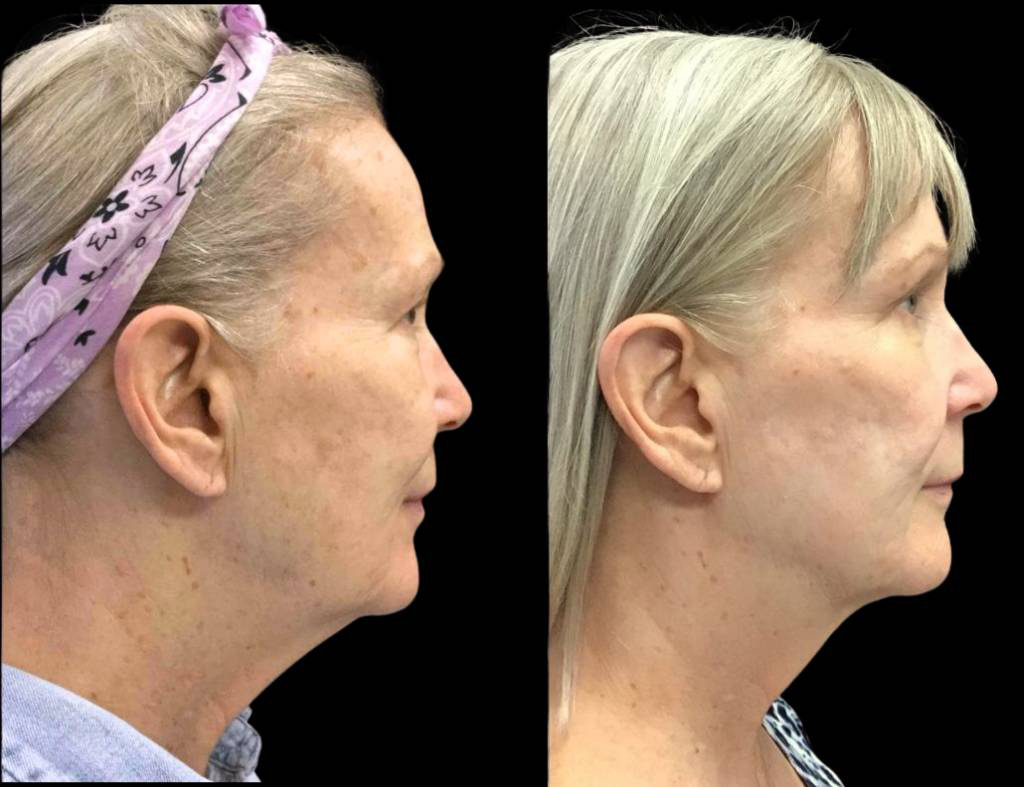 65-year-old-female-kybella-before-and-after-1.jpg