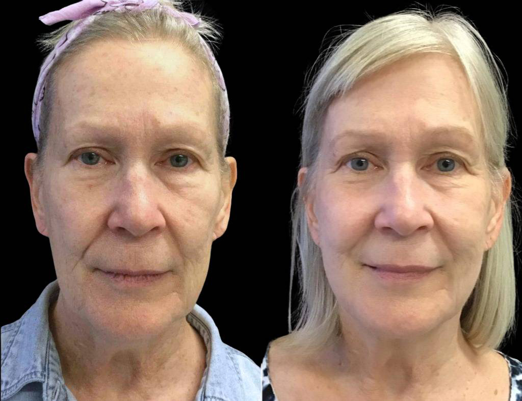 65-year-old-female-kybella-before-and-after.jpg