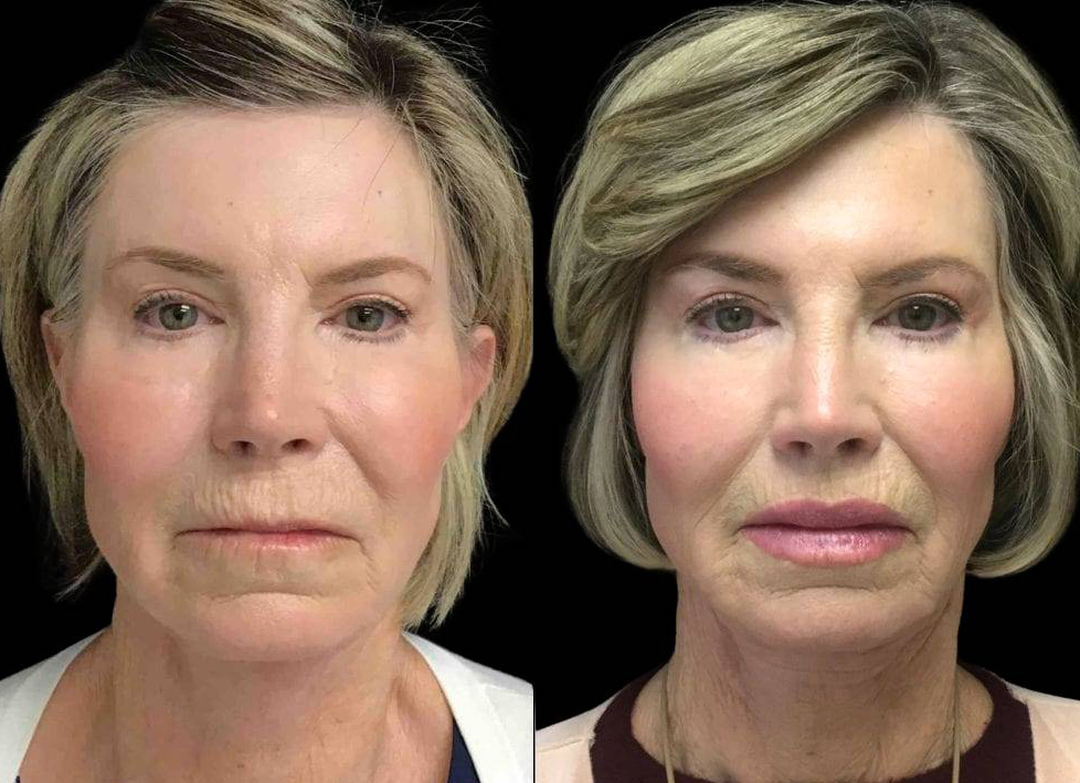 65-year-old-female-lip-lift-before-and-after-front-view-1.jpg