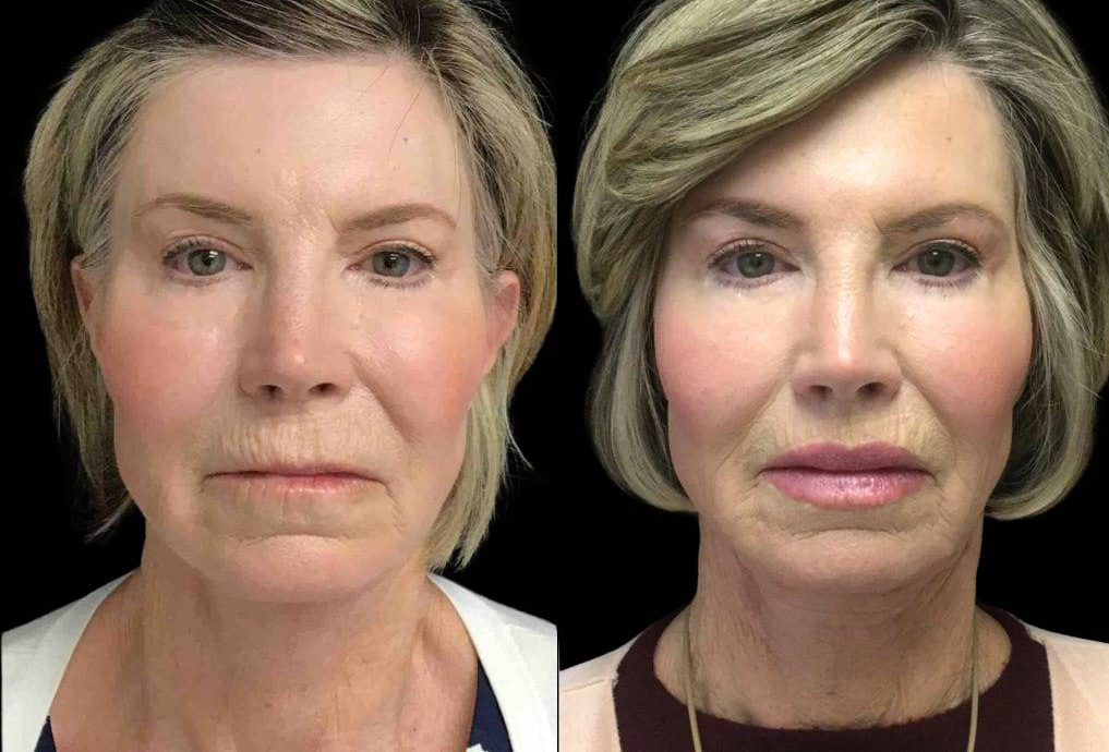 65-year-old-female-lip-lift-before-and-after-front-view-1.jpg