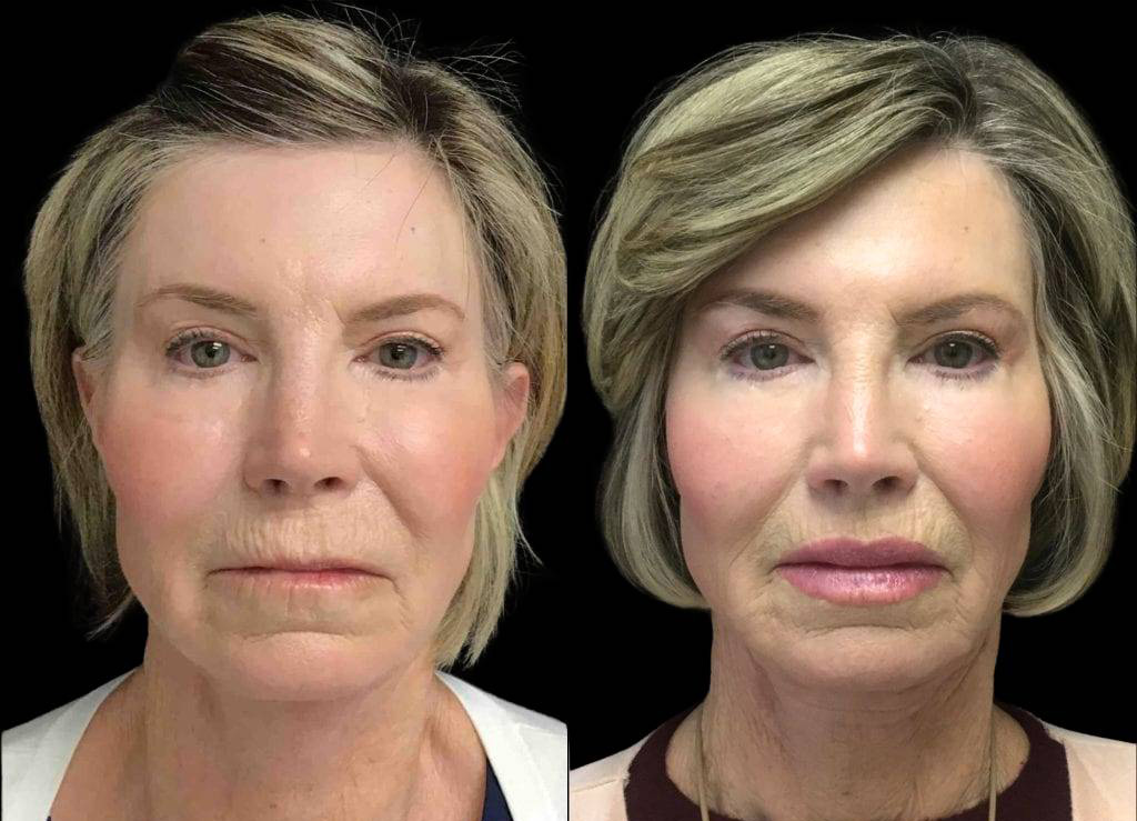 65-year-old-female-lip-lift-before-and-after-front-view-1.jpg