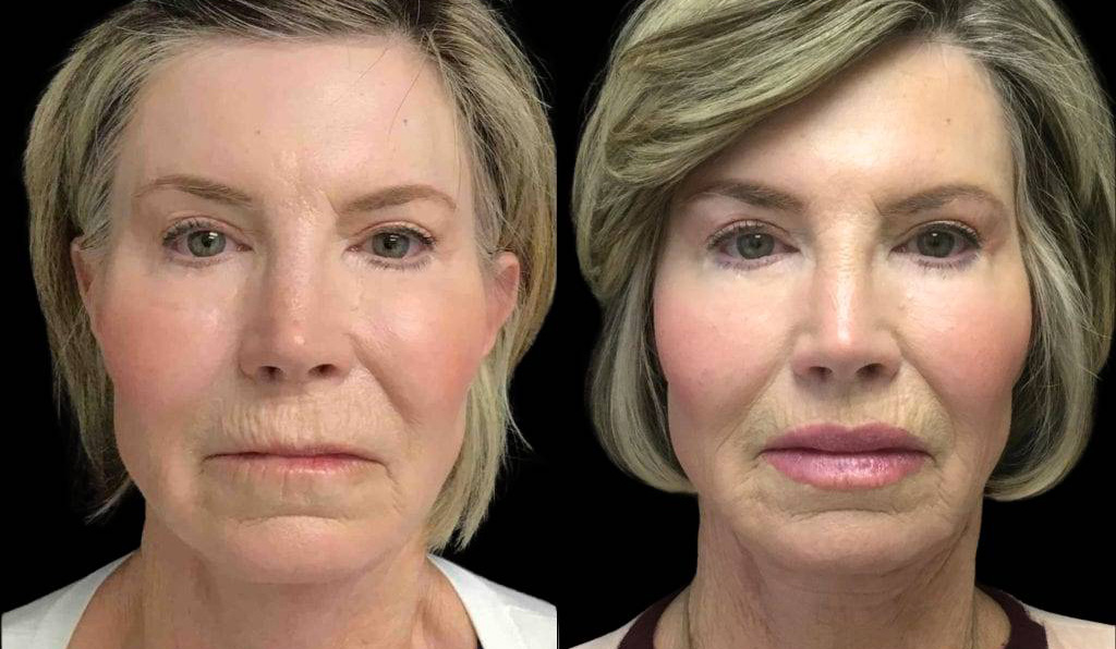 65-year-old-female-lip-lift-before-and-after-front-view-1.jpg