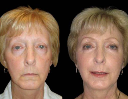 65-year-old-female-non-surgical-facelift-before-and-after-front-view.jpg