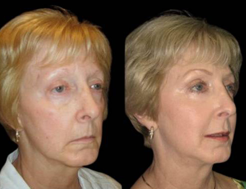 65-year-old-female-non-surgical-facelift-before-and-after-three-quarter-view.jpg