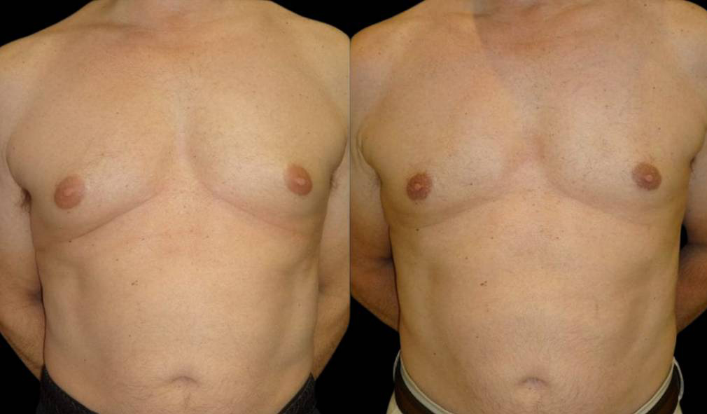 65-year-old-male-breast-reduction-before-and-after-front-view-15980.jpg