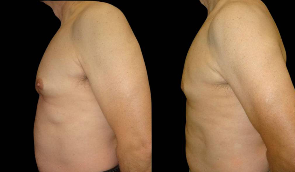 65-year-old-male-breast-reduction-before-and-after-side-view.jpg