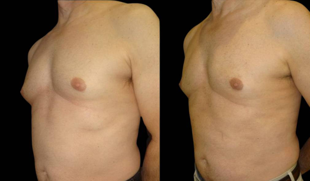 65-year-old-male-breast-reduction-before-and-after-three-quarter-view.jpg