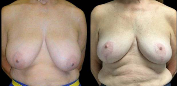 66-year-old-female-breast-reduction-before-and-after-front-view.jpg