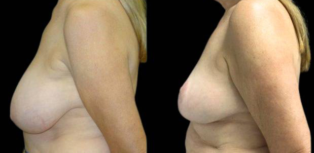 66-year-old-female-breast-reduction-before-and-after-side-view.jpg
