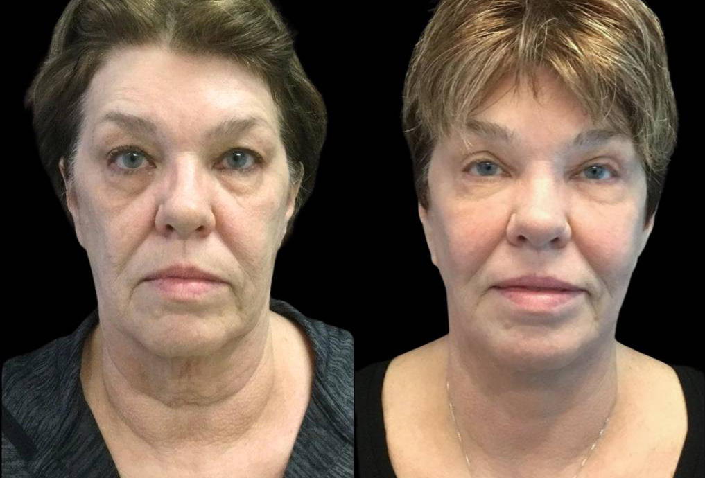 66-year-old-female-fractional-co2-laser-treatment-before-and-after-front-view.jpg