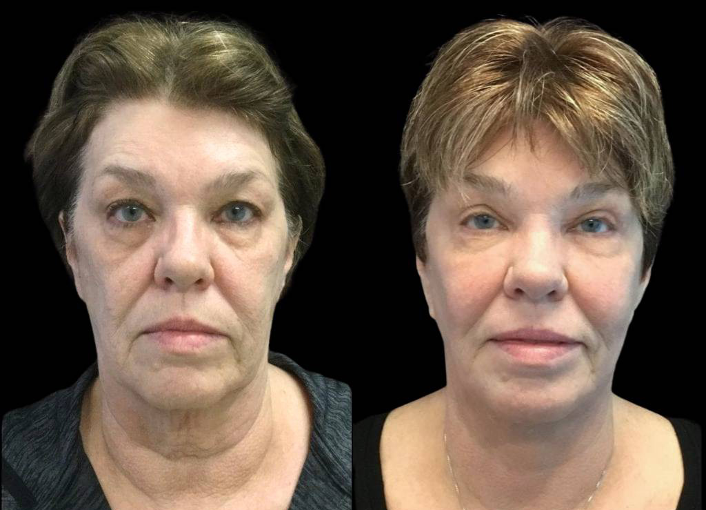 66-year-old-female-fractional-co2-laser-treatment-before-and-after-front-view.jpg