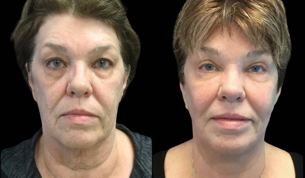66-year-old-female-fractional-co2-laser-treatment-before-and-after-front-view.jpg