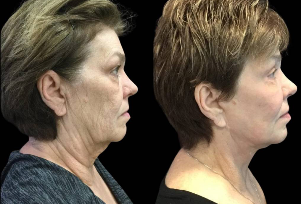 66-year-old-female-fractional-co2-laser-treatment-before-and-after-side-view.jpg