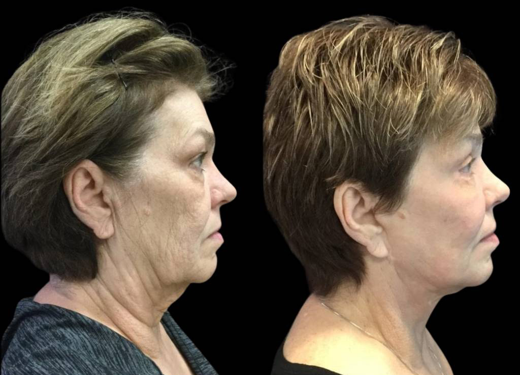 66-year-old-female-fractional-co2-laser-treatment-before-and-after-side-view.jpg