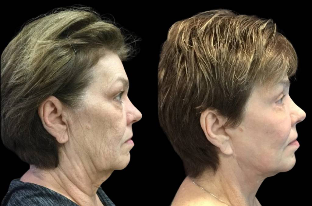 66-year-old-female-fractional-co2-laser-treatment-before-and-after-side-view.jpg