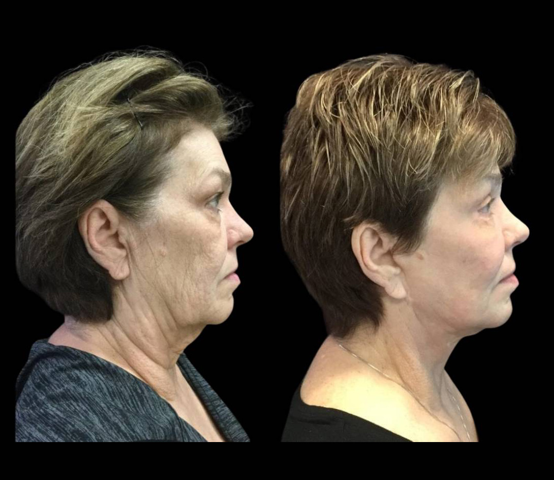 66-year-old-female-fractional-co2-laser-treatment-before-and-after-side-view.jpg