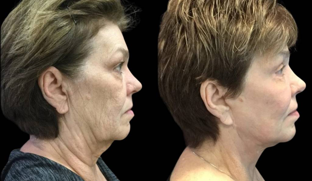 66-year-old-female-fractional-co2-laser-treatment-before-and-after-side-view.jpg