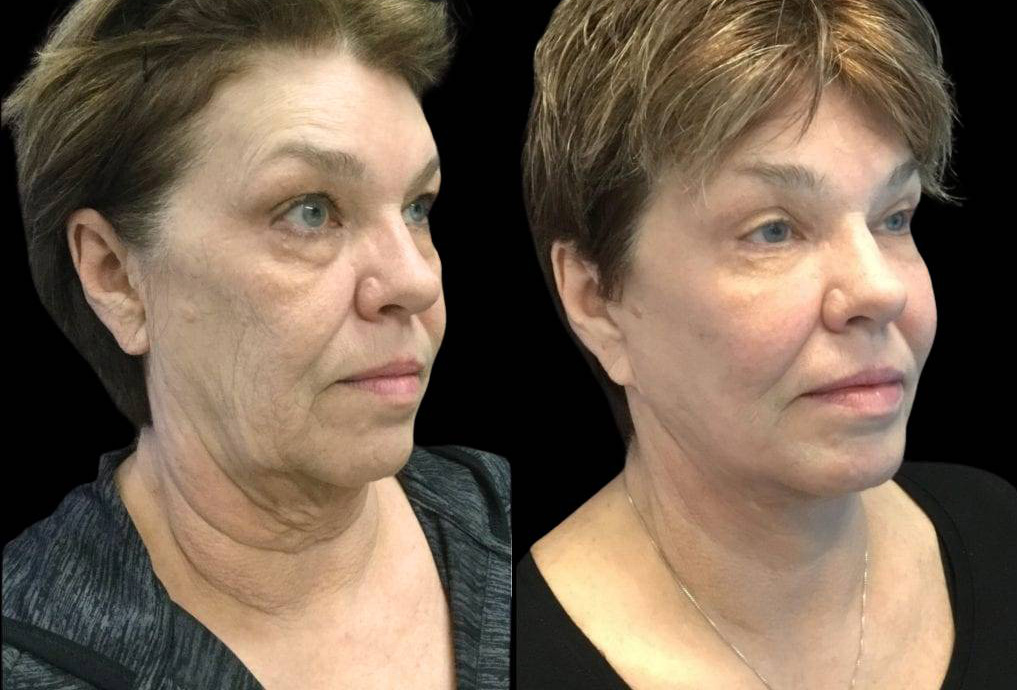 66-year-old-female-fractional-co2-laser-treatment-before-and-after-three-quarters-view.jpg