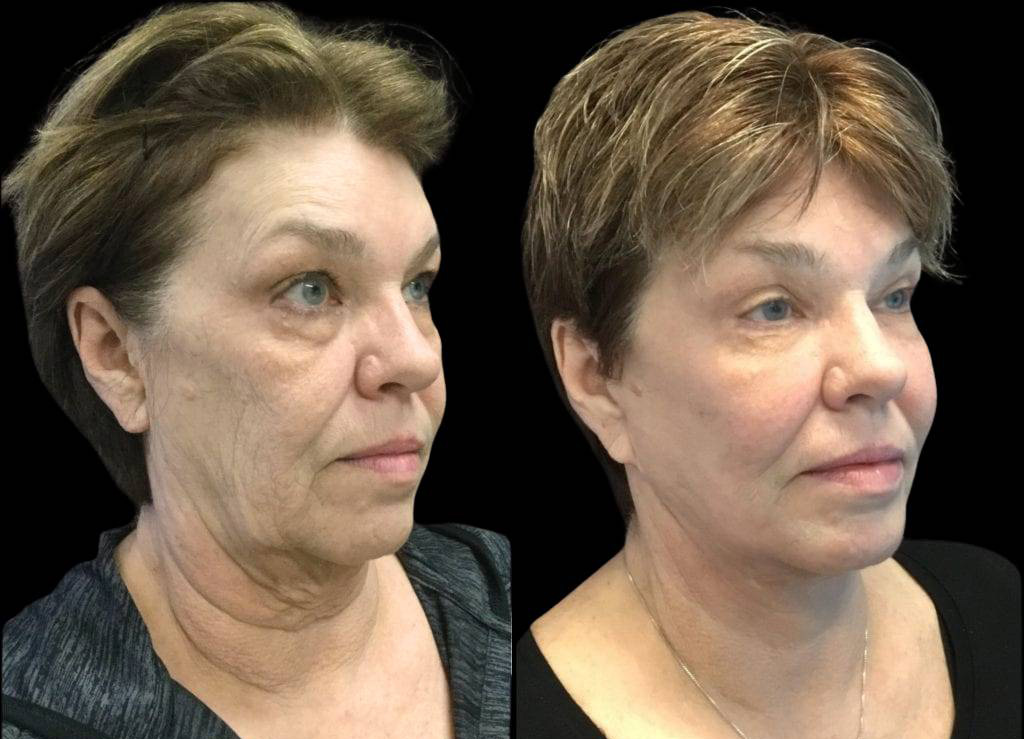 66-year-old-female-fractional-co2-laser-treatment-before-and-after-three-quarters-view.jpg