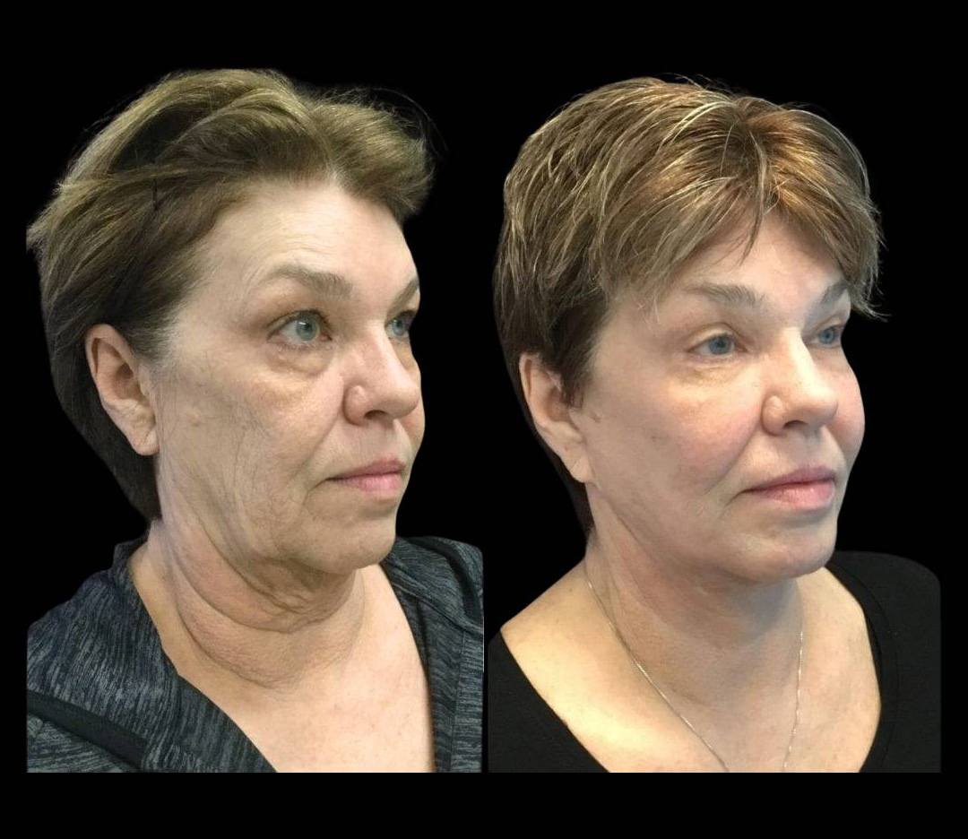66-year-old-female-fractional-co2-laser-treatment-before-and-after-three-quarters-view.jpg