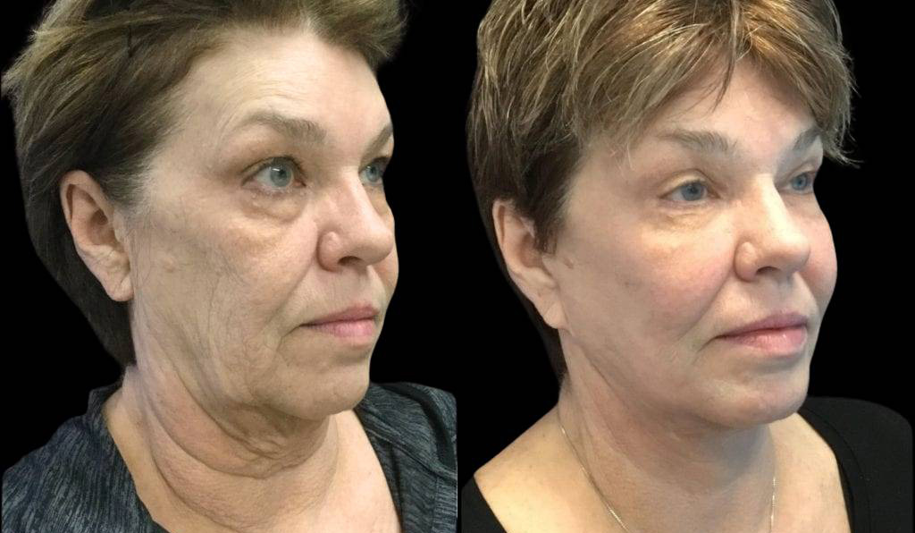 66-year-old-female-fractional-co2-laser-treatment-before-and-after-three-quarters-view.jpg