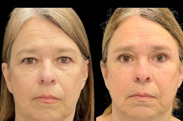 66-year-old-female-upper-and-lower-eyelid-lift-before-and-after-front-view-12663.jpg