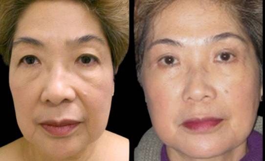 66-year-old-female-upper-and-lower-eyelid-lift-before-and-after-front-view-12663.jpg