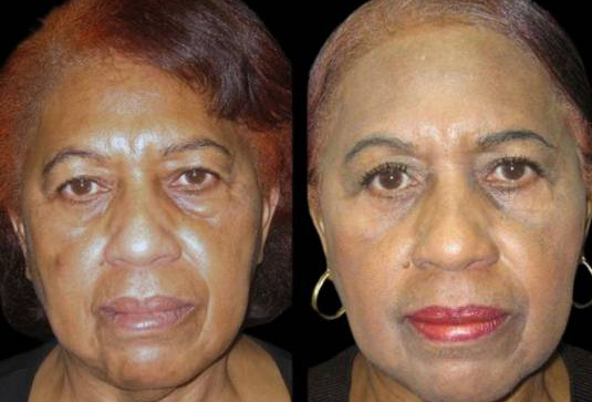 66-year-old-female-upper-and-lower-eyelid-lift-before-and-after-front-view-2746.jpg