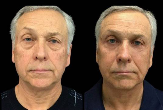 66-year-old-male-upper-and-lower-eyelid-lift-before-and-after-front-view-21214.jpg