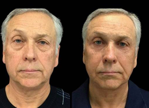 66-year-old-male-upper-and-lower-eyelid-lift-before-and-after-front-view-21214.jpg