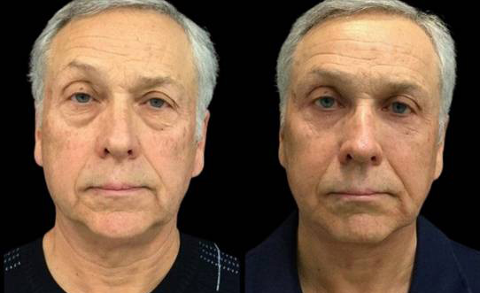 66-year-old-male-upper-and-lower-eyelid-lift-before-and-after-front-view-21214.jpg