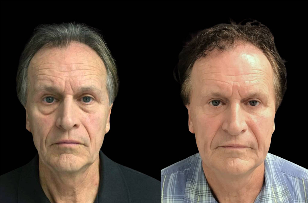 66-year-old-male-upper-and-lower-eyelid-lift-before-and-after.jpg