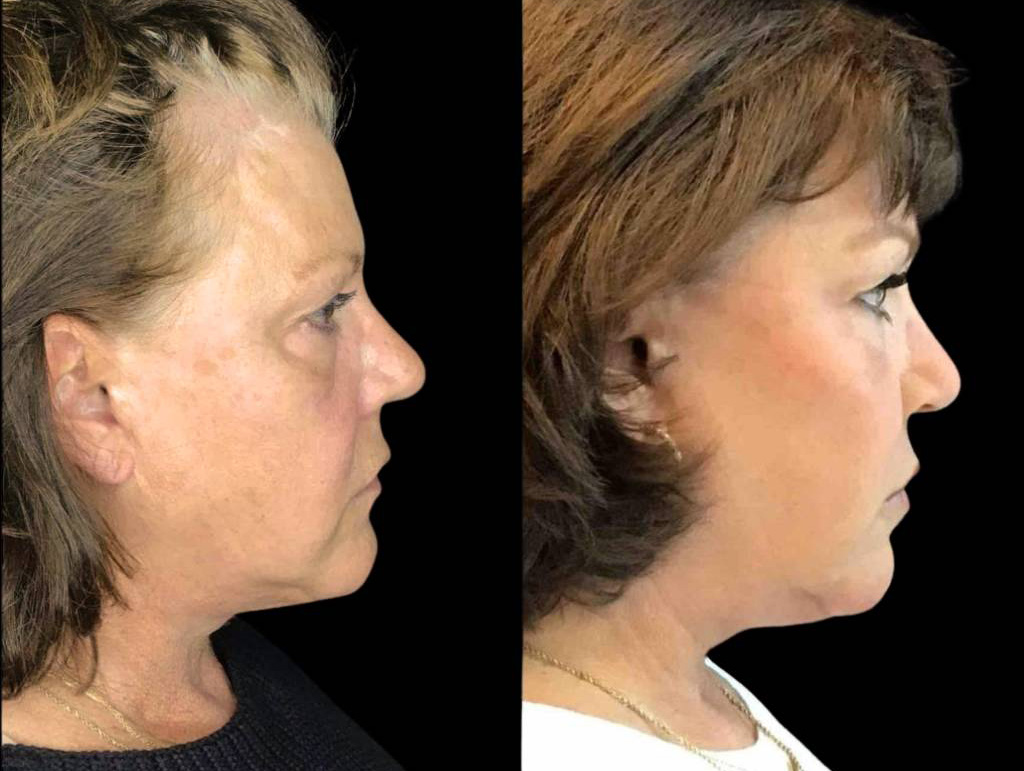 67-year-old-female-juvederm-before-and-after-side-view.jpg