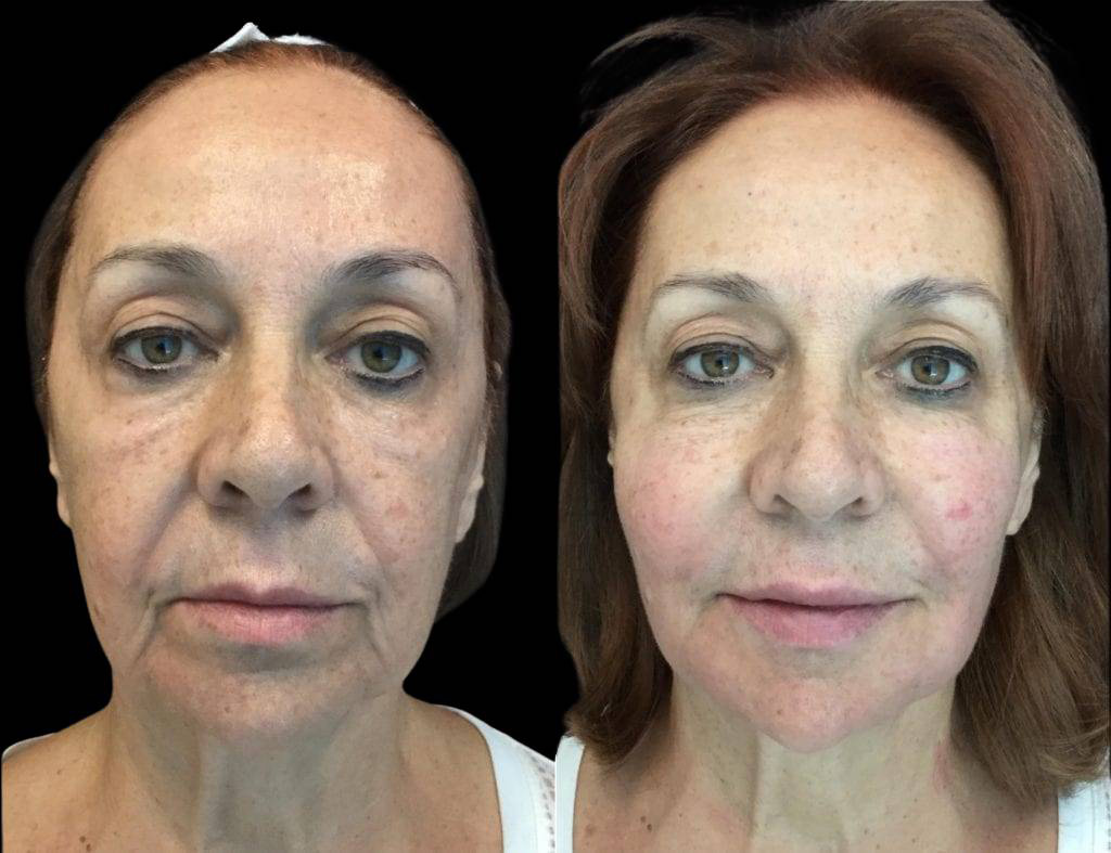 67-year-old-female-non-surgical-facelift-before-and-after-front-view-1207.jpg