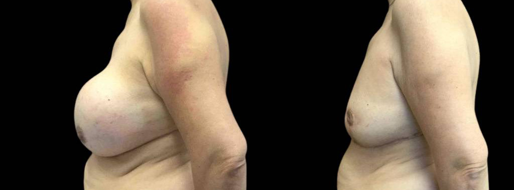 This is a 68-year-old female that has had a breast lift showing the before and after's side-by-side
