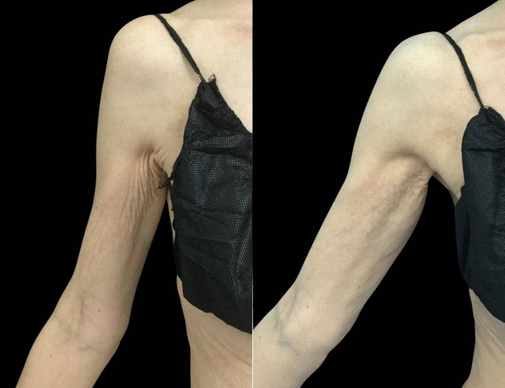 68-year-old-female-exilis-ultra-360-before-and-after-2.jpg