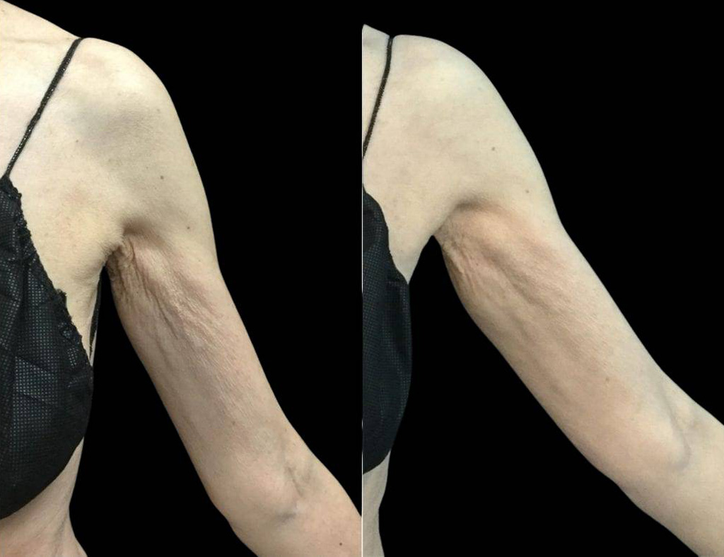 68-year-old-female-exilis-ultra-360-before-and-after.jpg