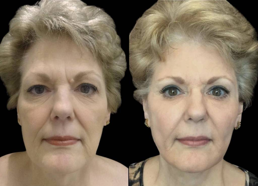 68-year-old-female-facelift-before-and-after-front-view-17468.jpg