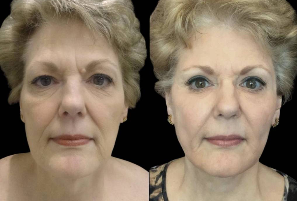 68-year-old-female-facelift-before-and-after-front-view-17468.jpg