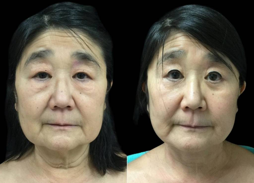 68-year-old-female-facelift-before-and-after-front-view-23931.jpg