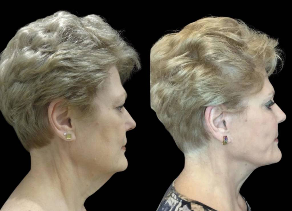 68-year-old-female-facelift-before-and-after-side-view.jpg