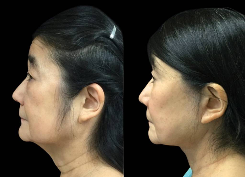 68-year-old-female-facelift-before-and-after-side-view-2.jpg