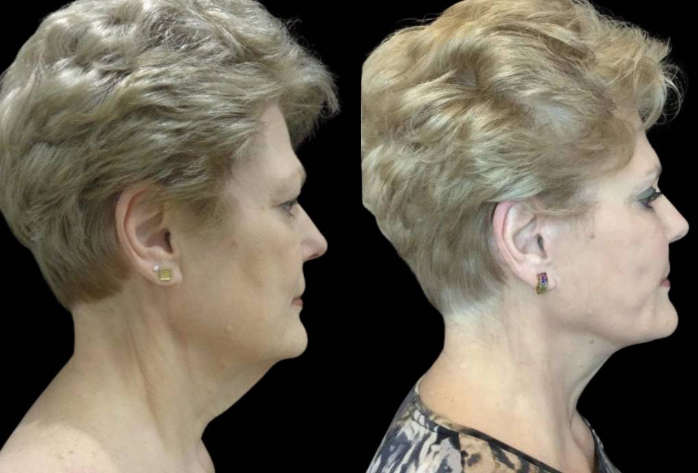 68-year-old-female-facelift-before-and-after-side-view.jpg