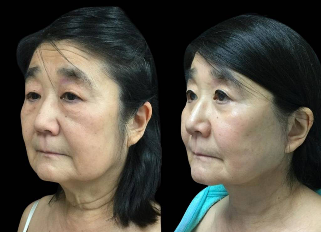 68-year-old-female-facelift-before-and-after-three-quarter-view-2.jpg