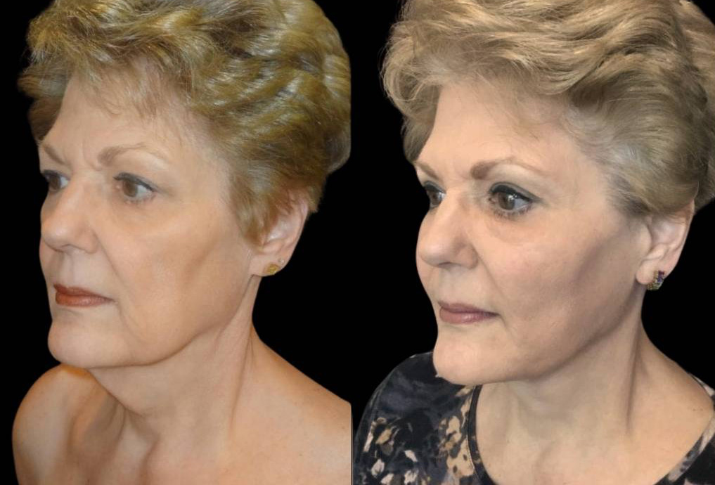 68-year-old-female-facelift-before-and-after-three-quarter-view.jpg