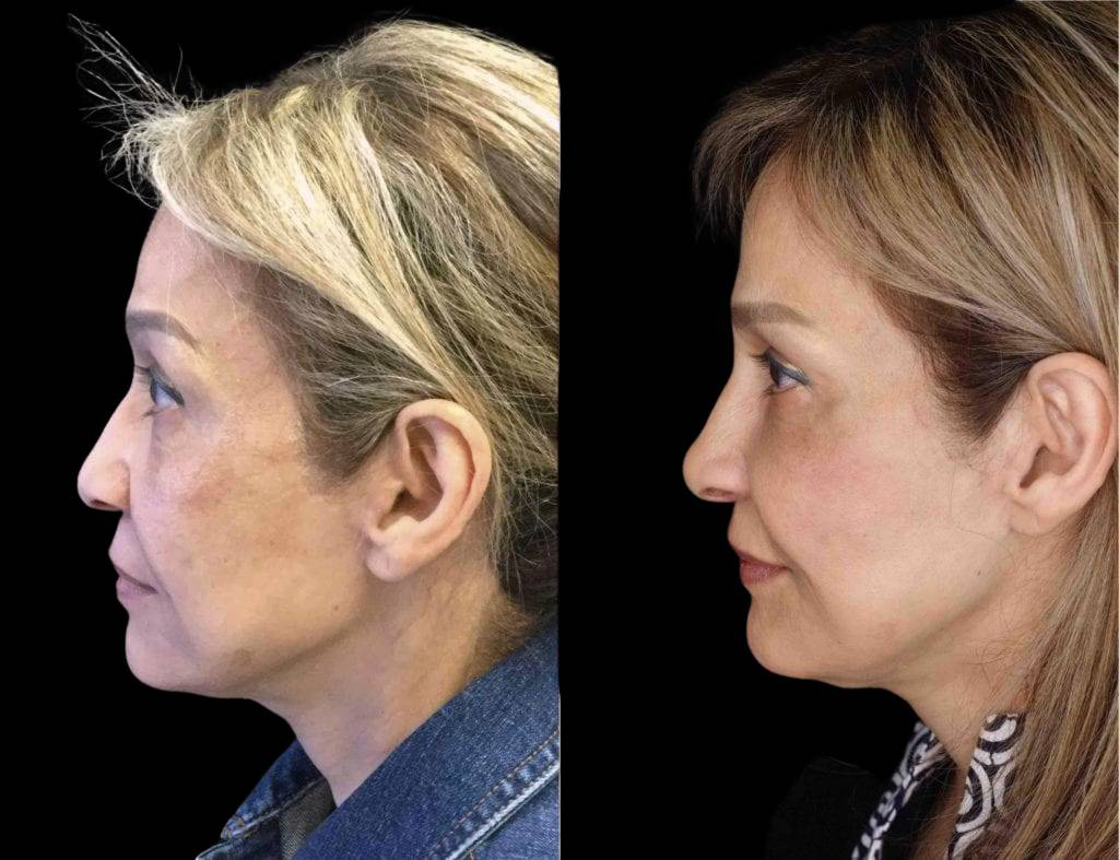 68-year-old-female-model-lift-before-and-after-side-view-29497.jpg