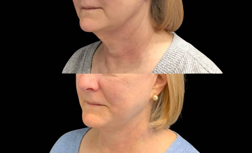 68-year-old-female-necklift-before-and-after-three-quarter-view.jpg