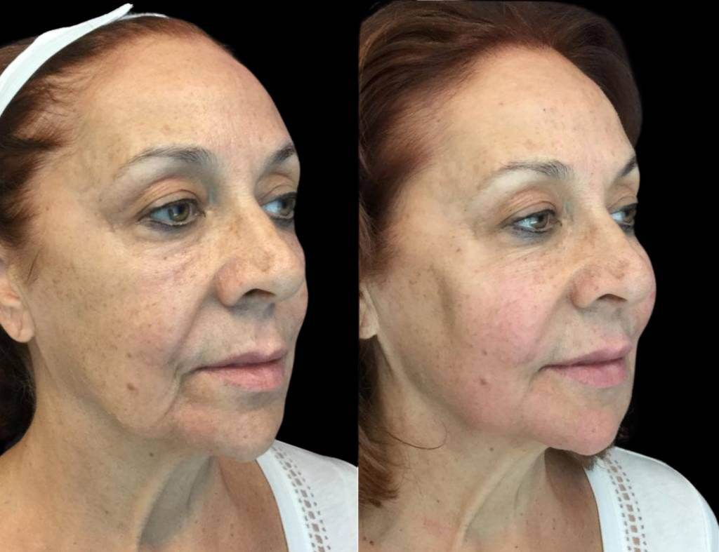 68-year-old-female-non-surgical-facelift-before-and-after-1.jpg
