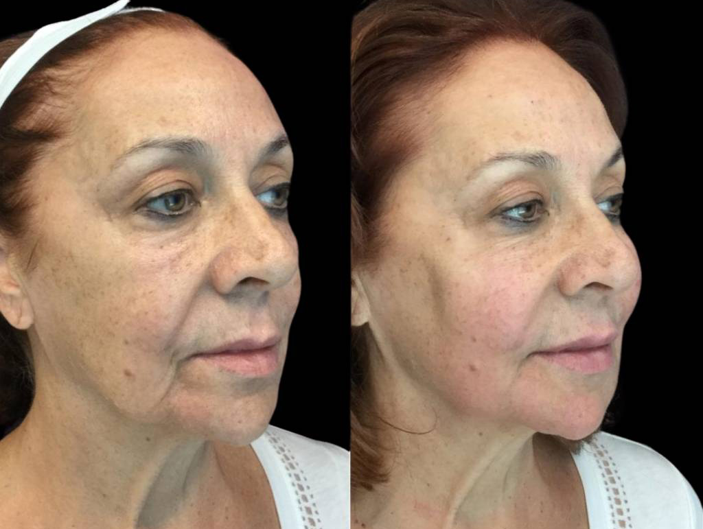 68-year-old-female-non-surgical-facelift-before-and-after-1.jpg